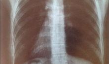 胸片爆料2023年最新,影像技术革新下的健康守护